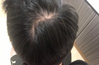 髪と頭皮を改善するヘアケア「AKFS PLUS」