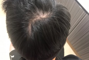 髪と頭皮を改善するヘアケア「AKFS PLUS」